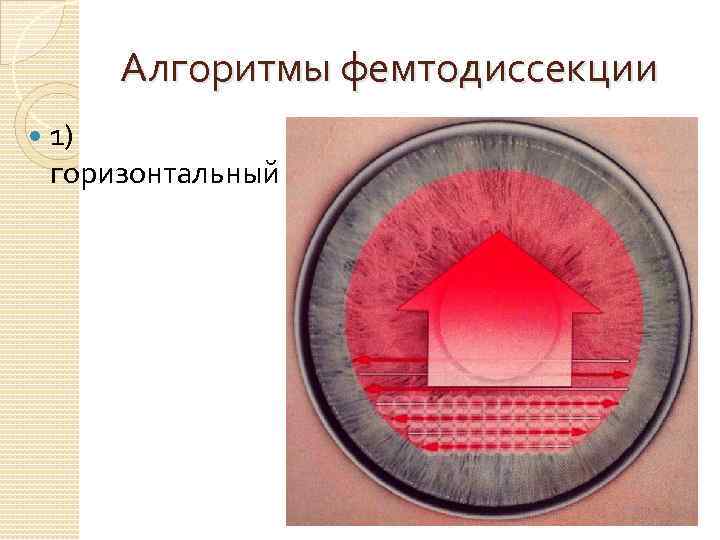 Алгоритмы фемтодиссекции 1) горизонтальный 