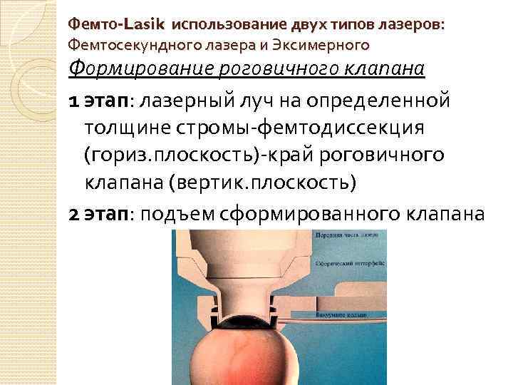 Фемто-Lasik использование двух типов лазеров: Фемтосекундного лазера и Эксимерного Формирование роговичного клапана 1 этап: