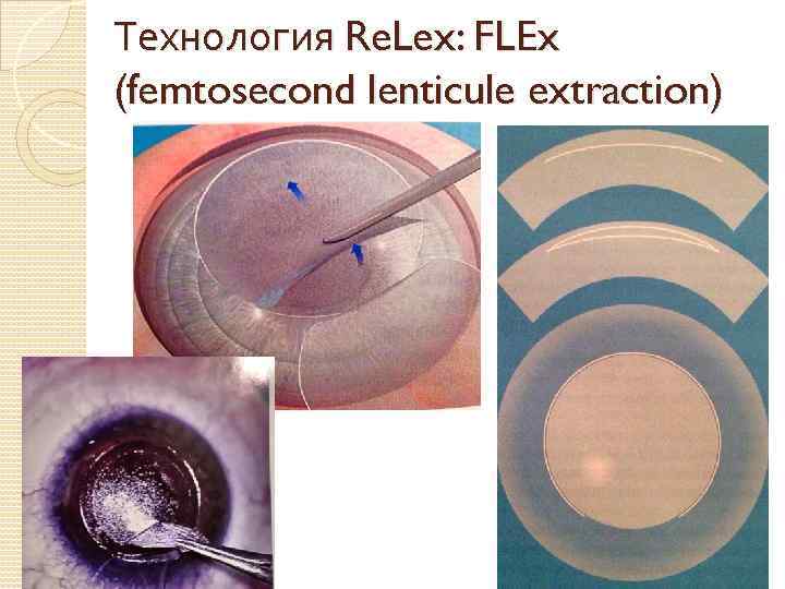 Технология Re. Lex: FLEx (femtosecond lenticule extraction) 