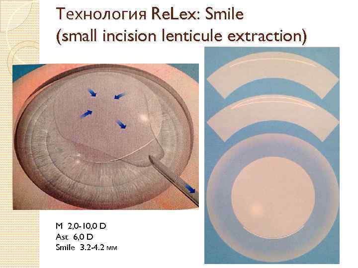 Технология Re. Lex: Smile (small incision lenticule extraction) M 2, 0 -10, 0 D