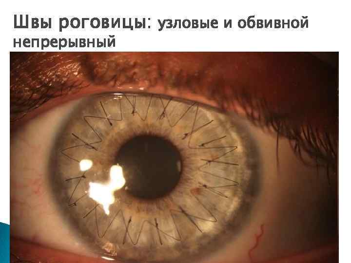 Швы роговицы: узловые и обвивной непрерывный 