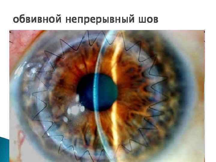 обвивной непрерывный шов 