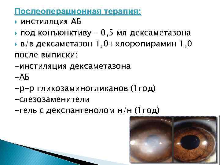 Послеоперационная терапия: инстиляция АБ под конъюнктиву – 0, 5 мл дексаметазона в/в дексаметазон 1,