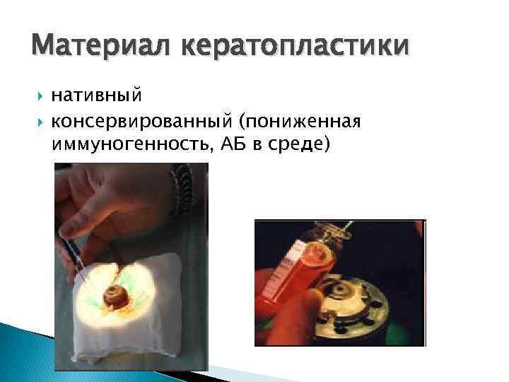 Материал кератопластики нативный консервированный (пониженная иммуногенность, АБ в среде) 