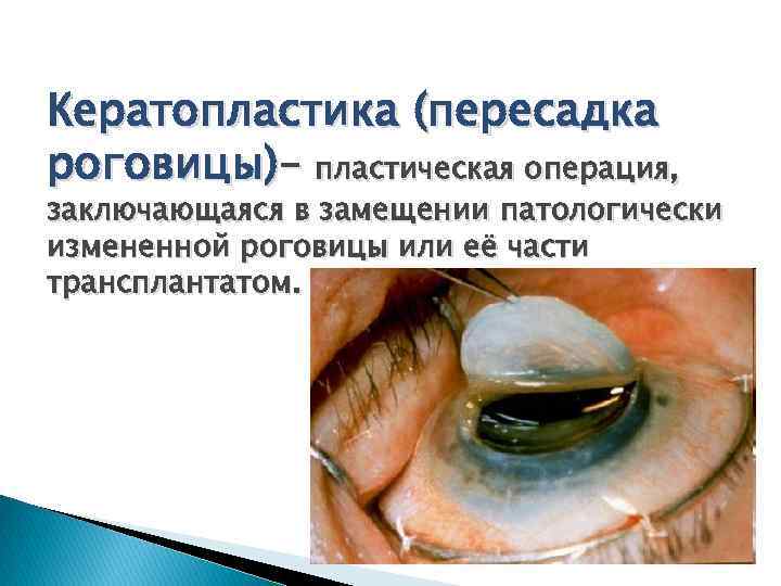 Кератопластика (пересадка роговицы)– пластическая операция, заключающаяся в замещении патологически измененной роговицы или её части