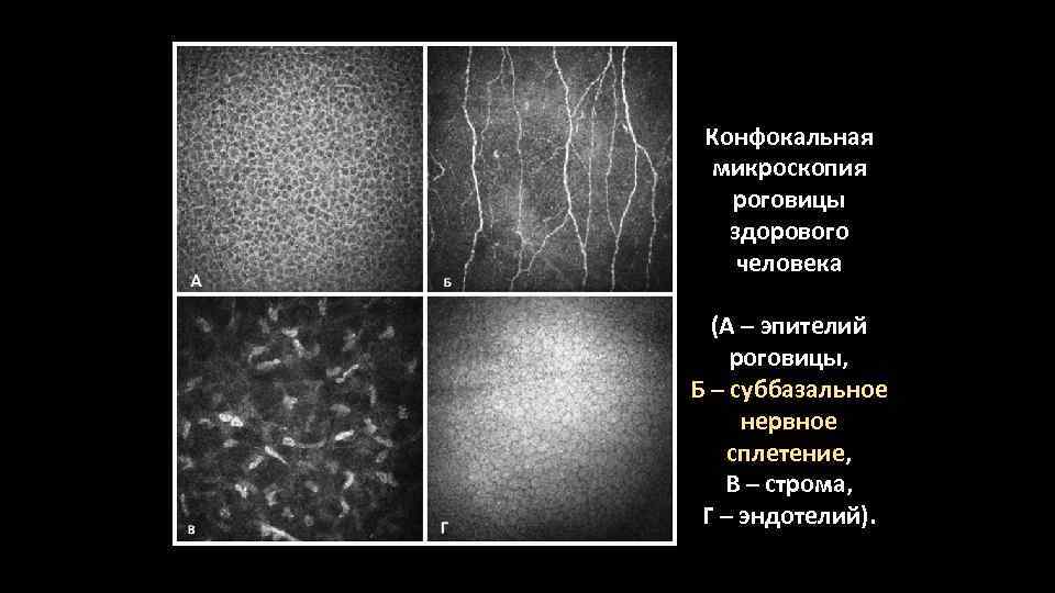 Конфокальная микроскопия. Конфокальная эндотелиальная микроскопия роговицы. Конфокальной микроскопии роговицы в норме. Корнеальная конфокальная микроскопия. Конфокальная микроскопия в офтальмологии.