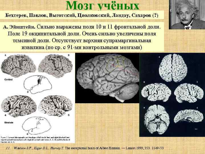 Мозг учёных Бехтерев, Павлов, Выготский, Циолковский, Ландау, Сахаров (? ) А. Эйнштейн. Сильно выражены