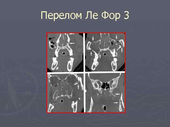 Перелом Ле Фор 3 