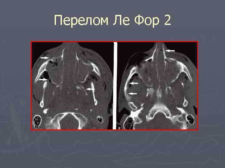 Перелом Ле Фор 2 