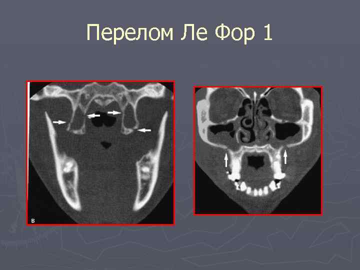 Перелом Ле Фор 1 