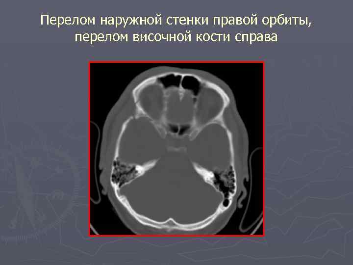Перелом наружной стенки правой орбиты, перелом височной кости справа 