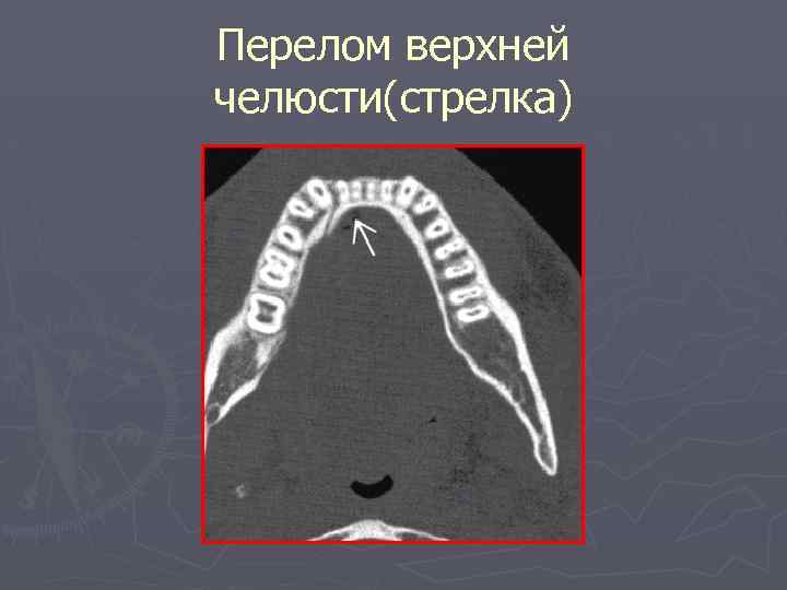 Перелом верхней челюсти(стрелка) 