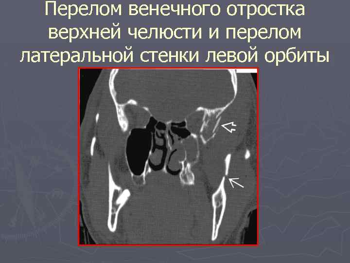 Перелом верхней стенки орбиты