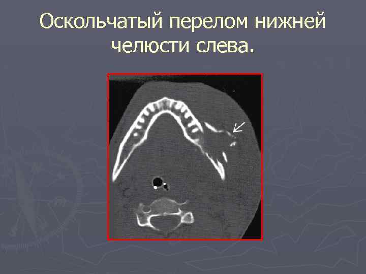 Оскольчатый перелом нижней челюсти слева. 