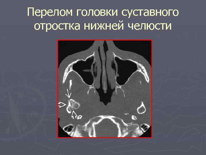 Перелом головки суставного отростка нижней челюсти 