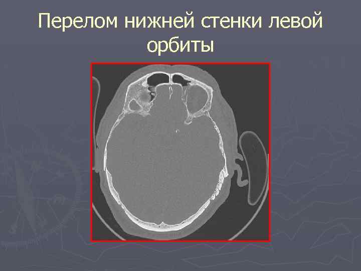 Перелом нижней стенки левой орбиты 