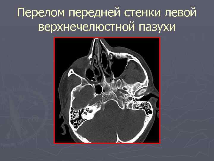 Перелом передней стенки левой верхнечелюстной пазухи 