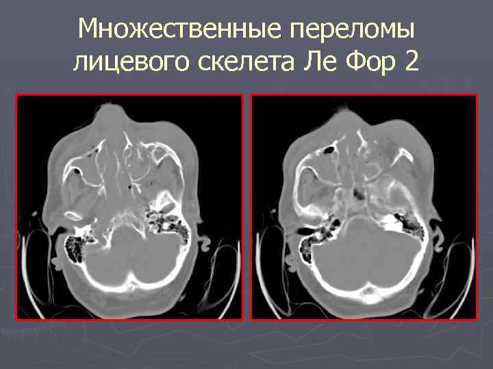 Множественные переломы лицевого скелета Ле Фор 2 