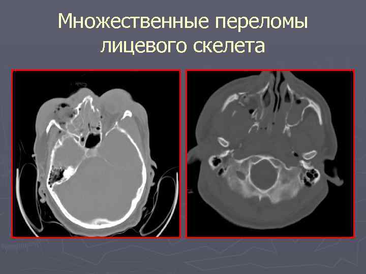 Множественные переломы лицевого скелета 