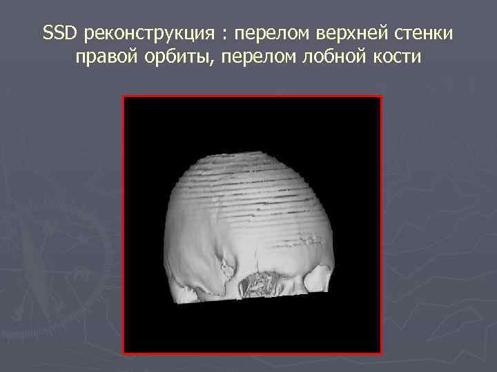 SSD реконструкция : перелом верхней стенки правой орбиты, перелом лобной кости 
