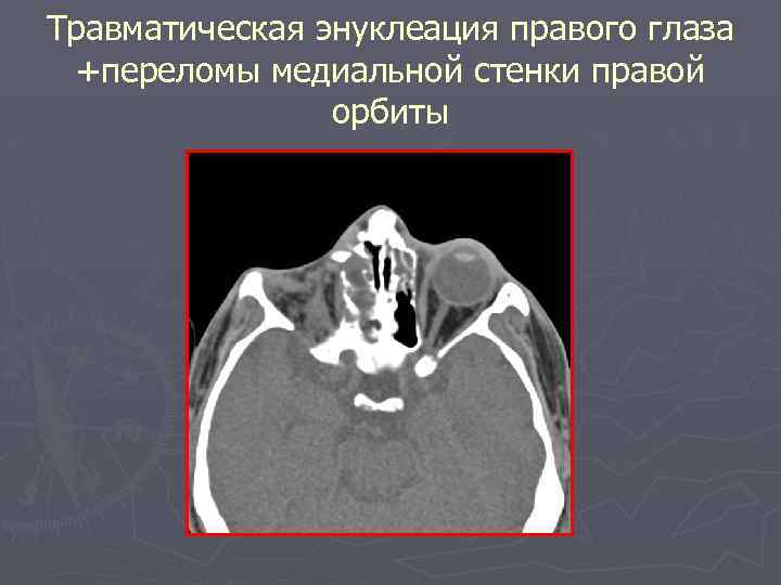 Травматическая энуклеация правого глаза +переломы медиальной стенки правой орбиты 