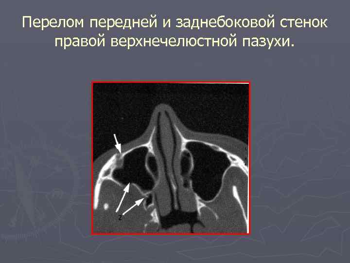 Перелом передней и заднебоковой стенок правой верхнечелюстной пазухи. 
