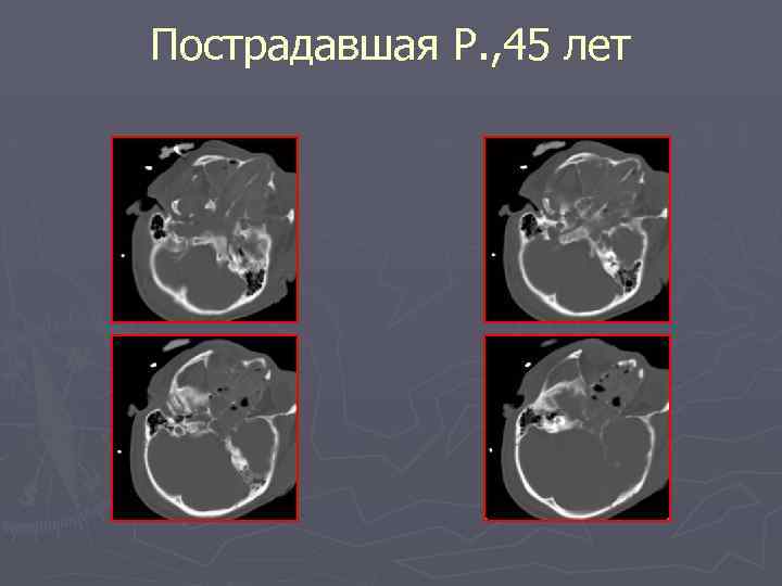 Пострадавшая Р. , 45 лет 