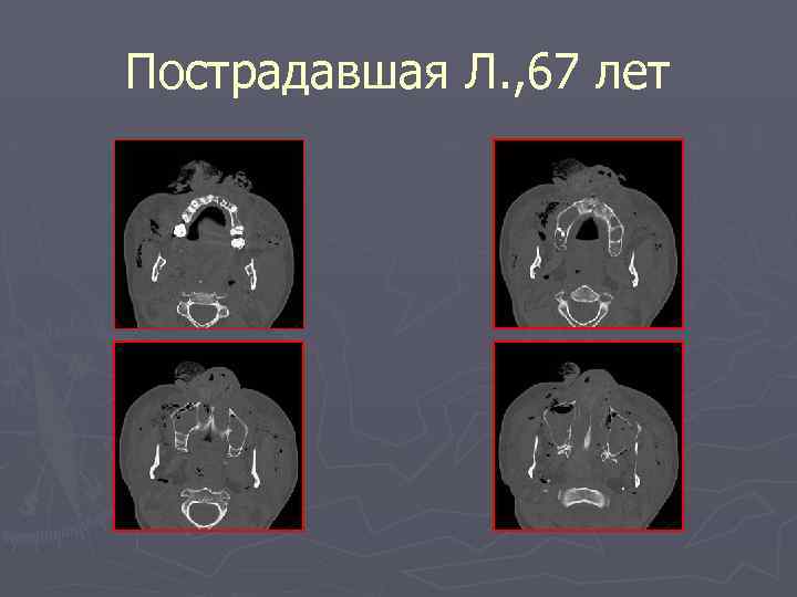 Пострадавшая Л. , 67 лет 