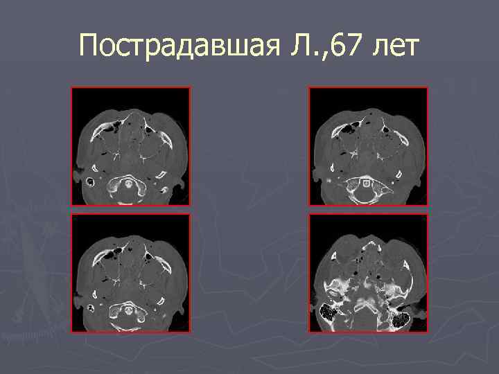Пострадавшая Л. , 67 лет 