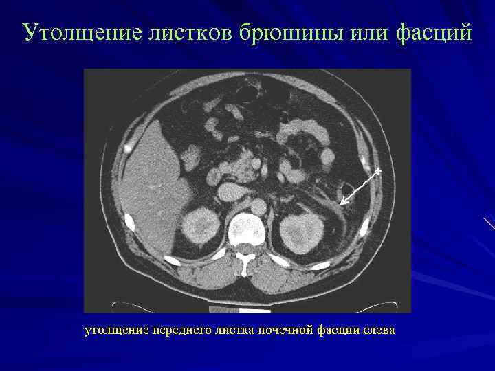 Утолщение листков брюшины или фасций утолщение переднего листка почечной фасции слева 