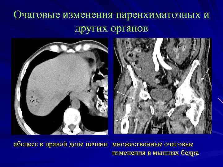 Очаговые изменения паренхиматозных и других органов абсцесс в правой доле печени множественные очаговые изменения