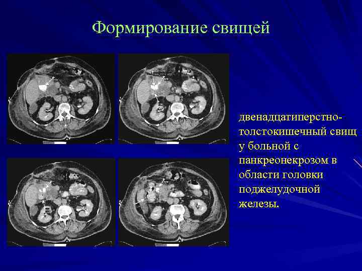 Формирование свищей двенадцатиперстнотолстокишечный свищ у больной с панкреонекрозом в области головки поджелудочной железы. 