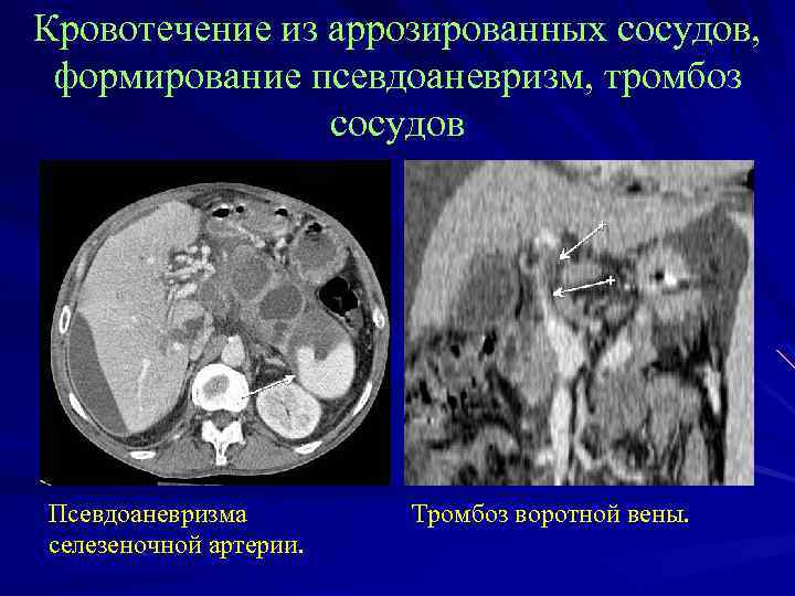 Кровотечение из аррозированных сосудов, формирование псевдоаневризм, тромбоз сосудов Псевдоаневризма селезеночной артерии. Тромбоз воротной вены.