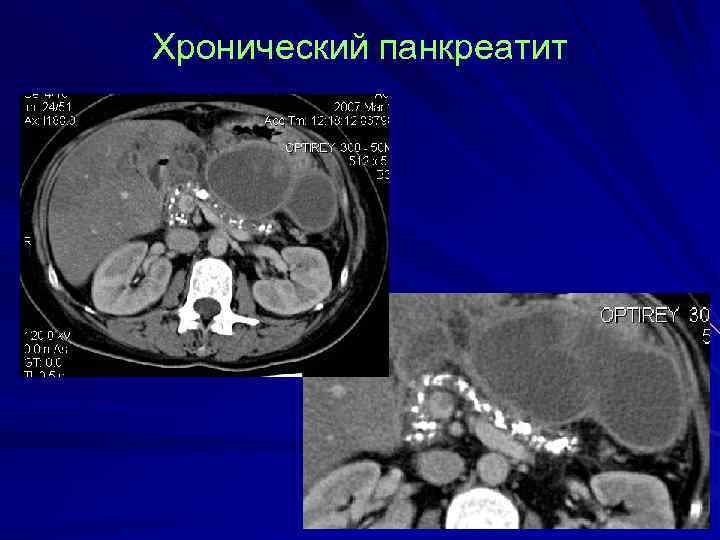 Хронический панкреатит 