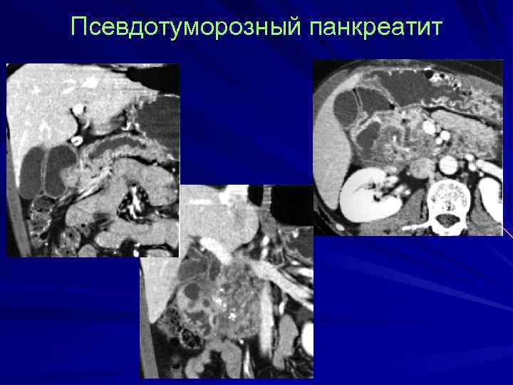 Псевдотуморозный панкреатит 
