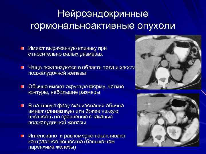 Нейроэндокринные гормональноактивные опухоли Имеют выраженную клинику при относительно малых размерах Чаще локализуются в области