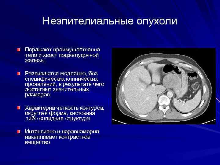Неэпителиальные опухоли Поражают преимущественно тело и хвост поджелудочной железы Развиваются медленно, без специфических клинических