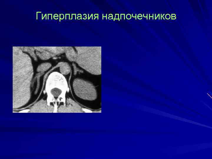 Гиперплазия надпочечников 