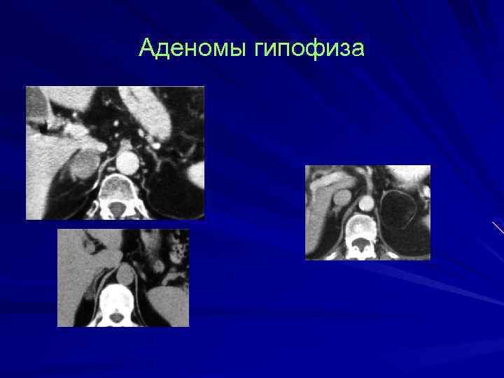Аденомы гипофиза 
