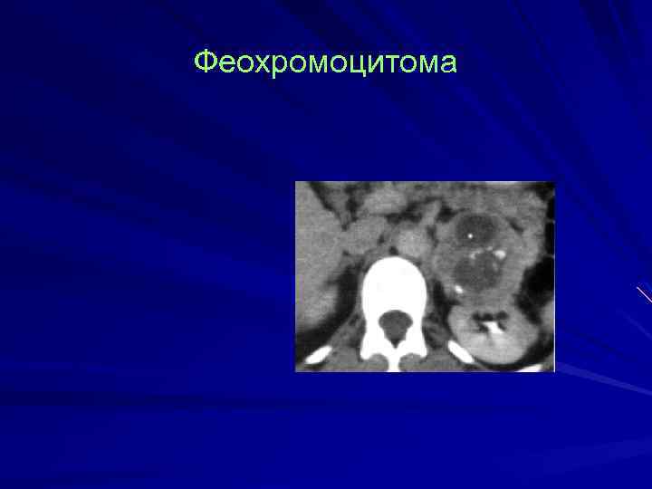 Феохромоцитома 