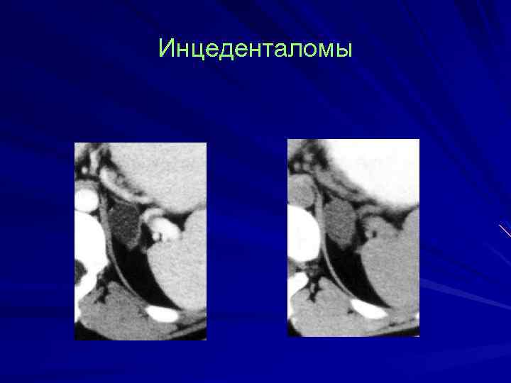 Инцеденталомы 