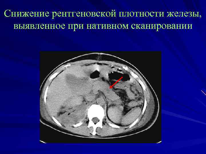 Снижение рентгеновской плотности железы, выявленное при нативном сканировании 