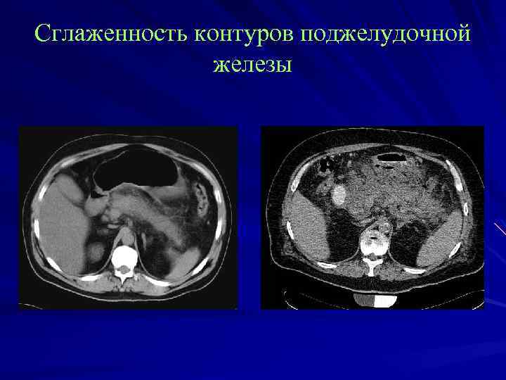 Сглаженность контуров поджелудочной железы 