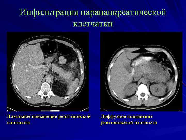 Инфильтрация парапанкреатической клетчатки Локальное повышение рентгеновской плотности Диффузное повышение рентгеновской плотности 
