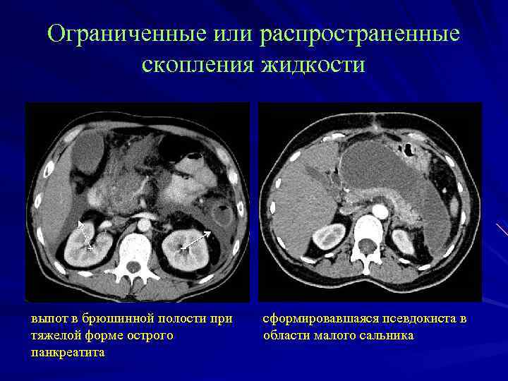 Ограниченные или распространенные скопления жидкости выпот в брюшинной полости при тяжелой форме острого панкреатита