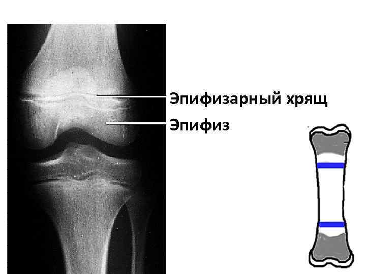 Эпифизарный хрящ