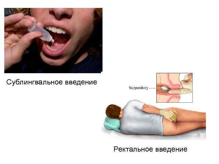 Сублингвальное введение Ректальное введение 