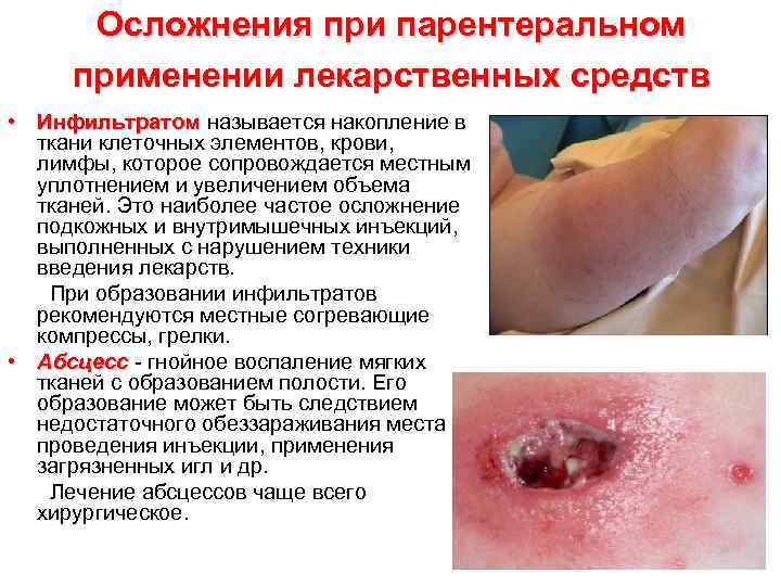 Осложнения при парентеральном применении лекарственных средств • Инфильтратом называется накопление в Инфильтратом ткани клеточных