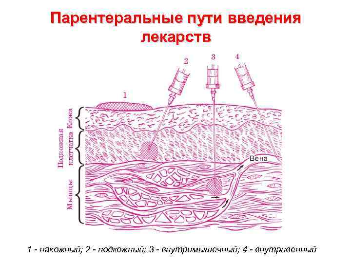 Парентеральный путь. Парентеральный путь введения лекарственных средств. Пути введения лекарственных средств парентерально внутримышечно. Инъекционные пути введения лекарственных препаратов. Парентеральный инъекционный путь введения.