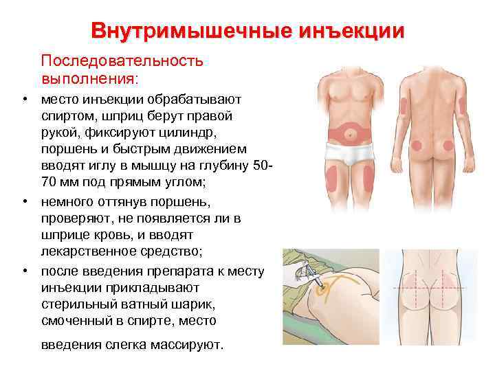 Внутримышечные инъекции Последовательность выполнения: • место инъекции обрабатывают спиртом, шприц берут правой рукой, фиксируют